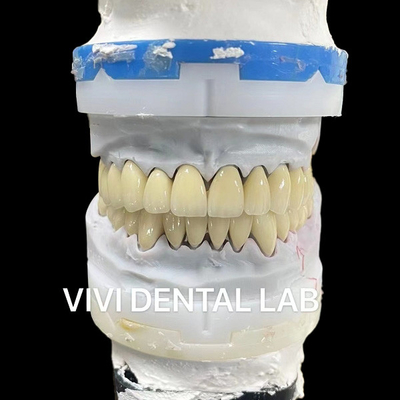 디지털 CAD CAM 치과 연구실 왕관 투명층 지르코니아 왕관