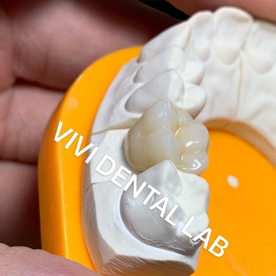 단단한 치아 실험실 크라운 3D 프로 높은 반투명 가득 찬 산화 지르코늄 크라운 중국 치아 실험실