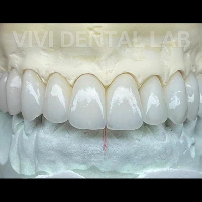치과실 Zirconia 왕관과 다리 작업 전문적인 안정