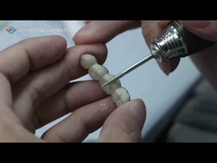 금속 세라믹 브릿지