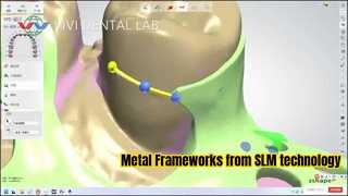 SLM 기술의 Metal Partial Framework